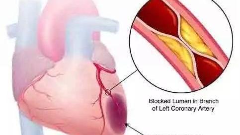 平安福与急性心肌梗塞(轻疾)的那些事儿