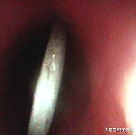 百天二胎宝宝胃里惊现异物, 原来是大孩子好奇心所致!