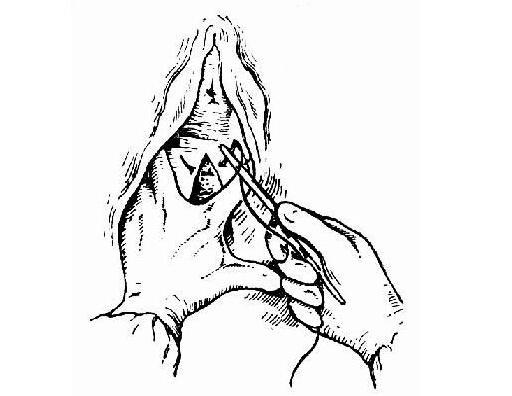 顺产也要挨一刀? 解读顺产侧切全过程!