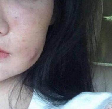 泰国美女每天坚持打美白针, 6年后皮肤发黑变成这样