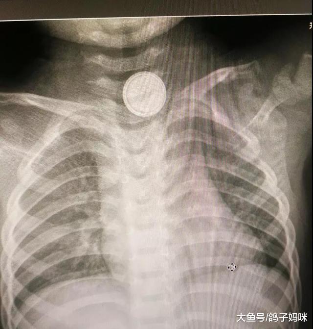纽扣式电池, 小儿异物中的危险分子
