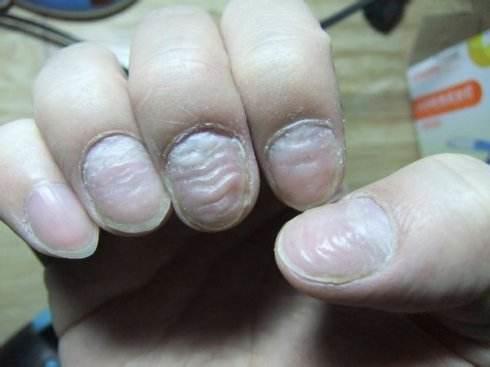 指甲上有它可能是患上了肝病, 赶紧去检查!
