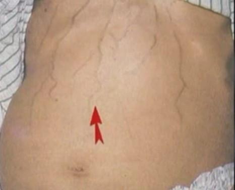 人体“青筋”凸起是大病前兆! 可惜许多人还以为是强壮的象征