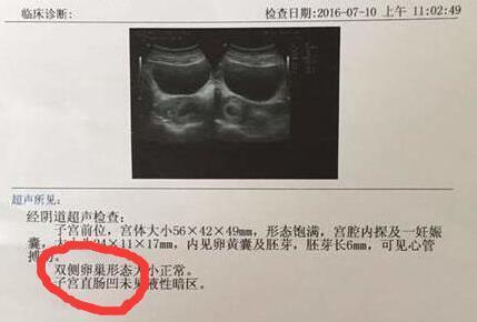 拿到B超单可以通过下面这几点查看胎儿性别