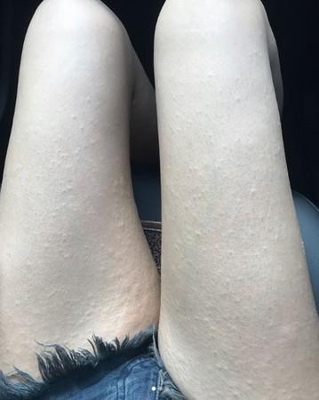 杨谨华晒自己得荨麻疹照片 大腿密密麻麻爬满疹子