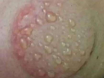 拔罐出水泡是湿气吗? 罐痕为什么颜色不同, 师傅技术不行?