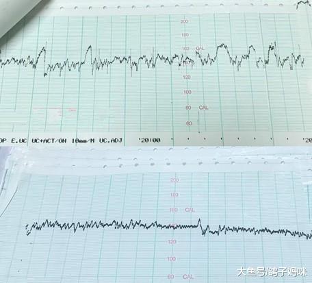 胎儿脐带竟打死结! 心跳奇怪, 改剖腹救回一命