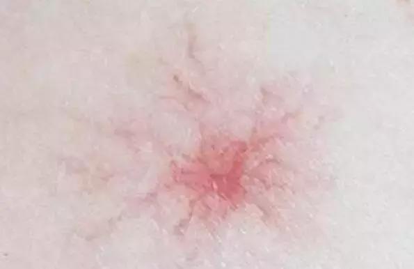 身上起小红点是怎么回事? 还是大病的预兆? 很多人忽视了