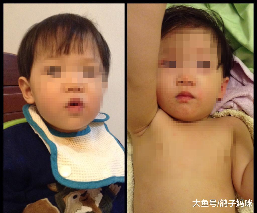 孩子莫名发烧, 幼儿心脏隐形杀手, 川崎病