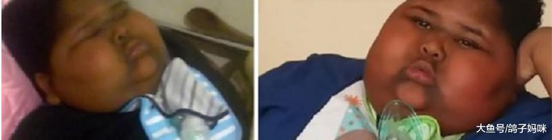 吃不饱的小胖威利症! 染色体异常, 产检别轻视