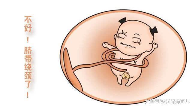 脐带绕颈还可以顺产吗? 做好3件事, 孕妈放宽心