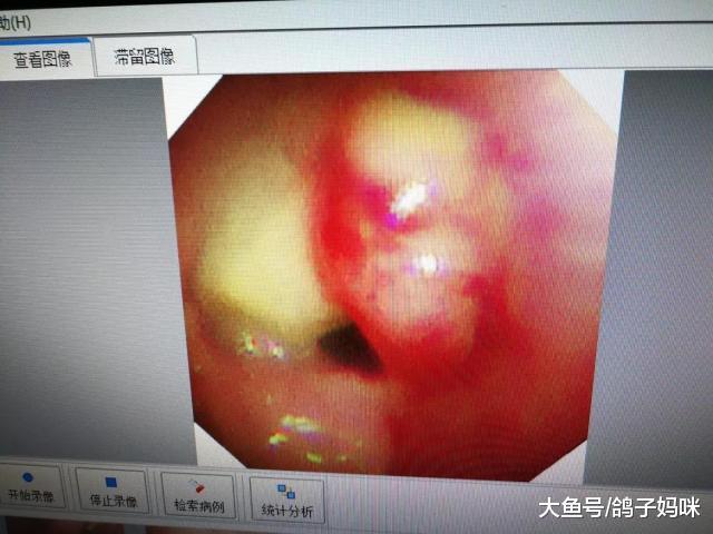 气管异物的急救, 很实用, 有宝宝的家长要学习