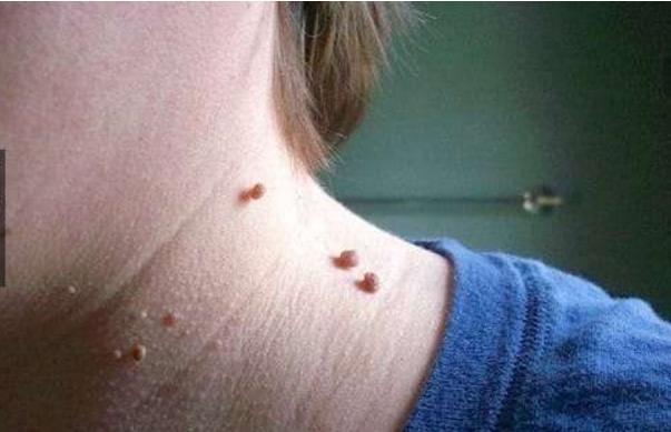脖子长很多小肉粒, 说明身体出了问题, 长期下去会很严重!