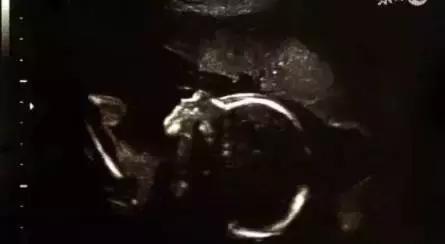 B超孕囊, 四维彩超真的可以辨别男女吗, 宝妈经验分享