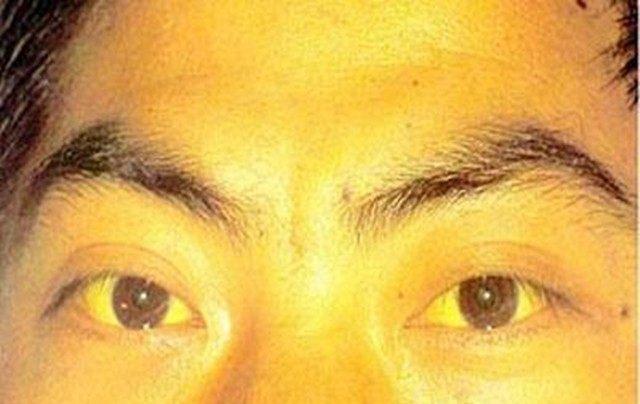 身体1处发白, 2处发黄, 2处变红, 这是肝脏在求救, 要引起警惕