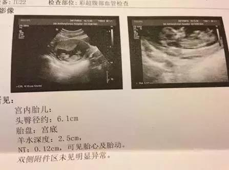 B超孕囊, 四维彩超真的可以辨别男女吗, 宝妈经验分享