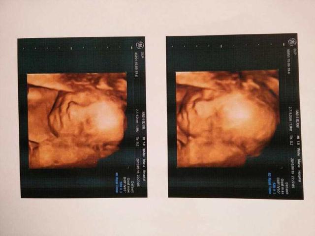 四维彩超怎么看? 五大项目帮你鉴别宝宝健康