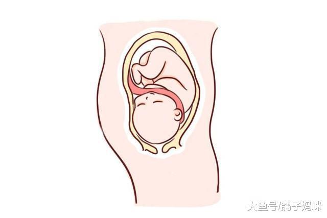 产检发现脐带绕颈, 胎宝宝有危险吗?
