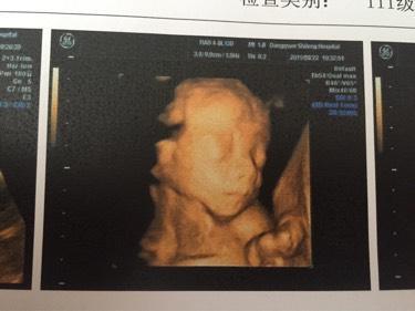 小棉袄顺利通过四维大排畸, 孕期症状分享