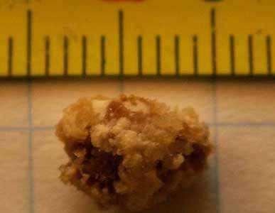 男子肾结石420颗, 原因是常吃这种最嫩最补的菜!