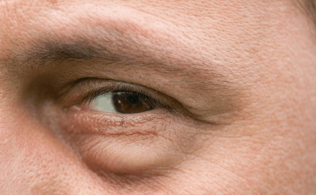 专家提醒: 6种皱纹, 是健康报警, 不可忽视! 耳垂皱纹最危险!