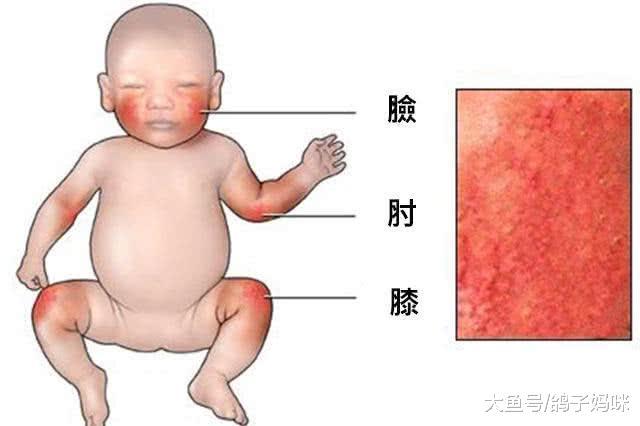 婴儿玫瑰疹, 会传染吗? 要不要替宝宝退烧?