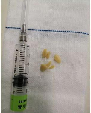 3岁幼童喝了加料的粥窒息! 医生: 这些东西别随意给孩子吃!