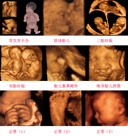 四维彩超可以这么分辨胎宝宝性别, 您看哪个方法比较准