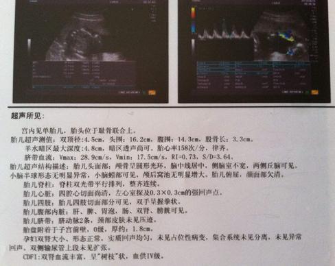 孕40周2天, 顺产6斤男宝宝, 附孕期B超单
