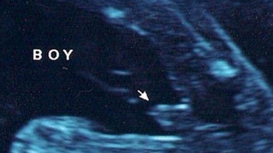 四维B超看男女准吗? 教您如何通过四维彩超判断男女