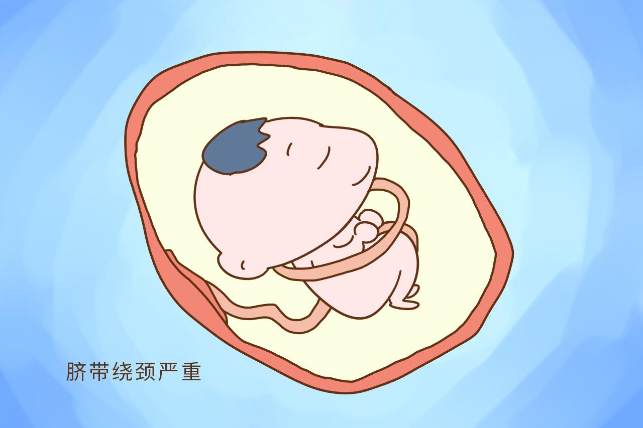 如果你是这3类孕妈, 很遗憾告诉你只能剖腹产了