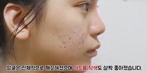 一女子脸上放着一只水蛭却不着急取下, 当把水蛭拿下后却感到神奇