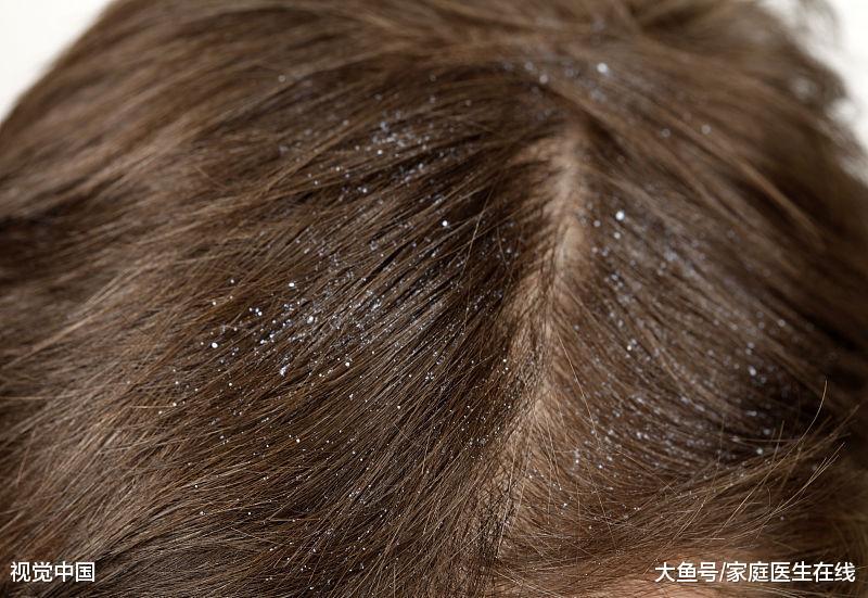 头皮屑多是怎么回事? 不把这3个原因搞清楚, 会一直没完没了