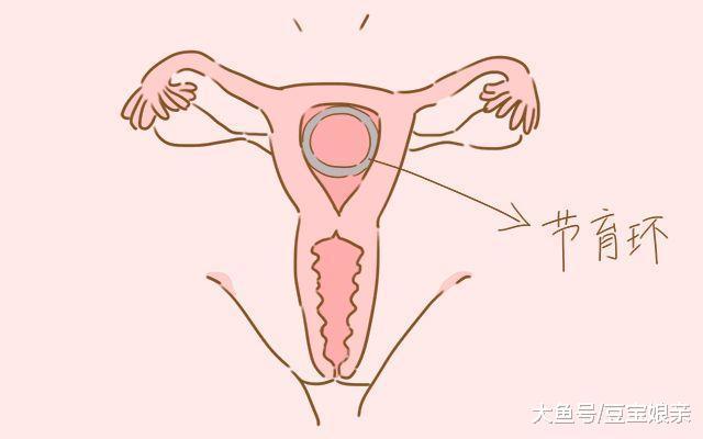上环还是结扎? 看完两者的区别, 可能你就不纠结了
