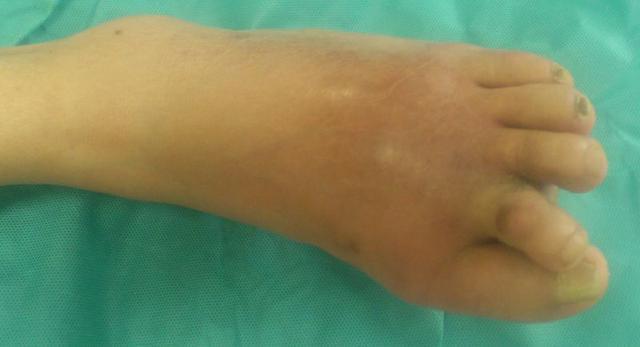 医生告诫: 脚趾有这3个特征, 90%都得了糖尿病, 早发现早救命!