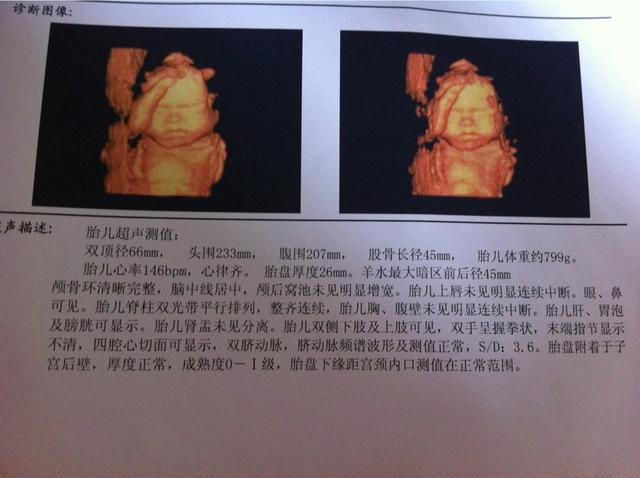 四维大排畸顺利归来, 分享下怀女宝的症状及肚型
