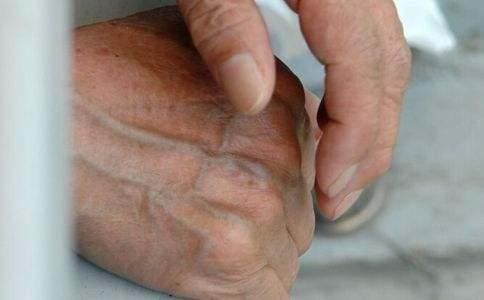 人体“青筋”凸起是大病前兆! 可惜许多人还以为是强壮的象征