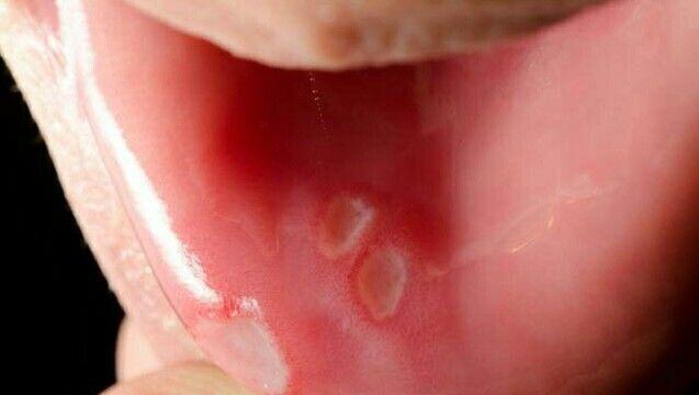 口腔溃疡反复发作? 做好5件事, 远离溃疡, 口腔更健康