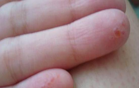 手上起小水泡是怎么回事? 那是大病的预兆?