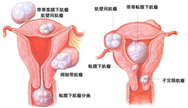 子宫肌瘤最喜欢这3类食物, 贪吃一口, 只会让子宫肌瘤越来越大!