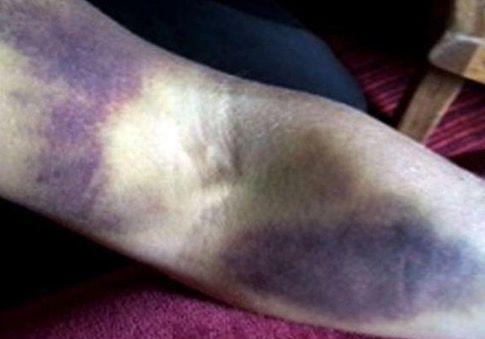 女人身上有淤青, 去医院检查才知得了绝症, 都听过总被我们忽略