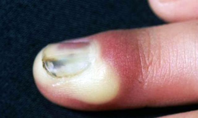 身体2处变黑, 可能是肝癌, 多吃这3种食物, 排肝毒让肝脏干净如新!