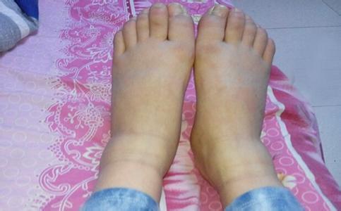 你的脚出现这几种状况, 说明你的身体已经出现不同的疾病! 很危险