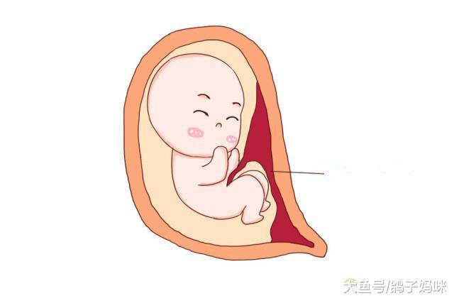 怀孕35周却痛失宝宝, 只因为胎盘早剥!