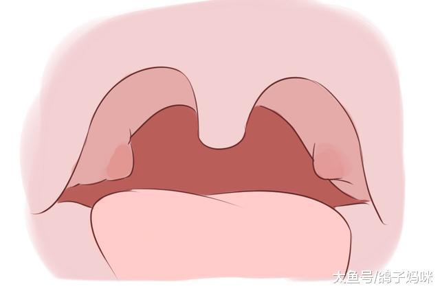 小孩打呼怎么办? 腺样体和扁桃体肥大!