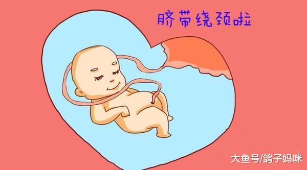 脐带绕颈、胎心下降, 脐带隐性脱垂异常危险!