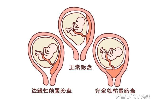 怀孕出血是流产信号? 认识妊娠前、中、后期出血原因