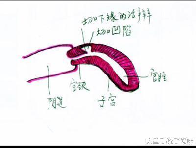 剖宫产切口憩室, 这么一个小洞, 差点要命!