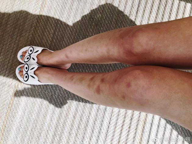 林允方回应腿部淤青: 吊威亚及下水拍戏所致