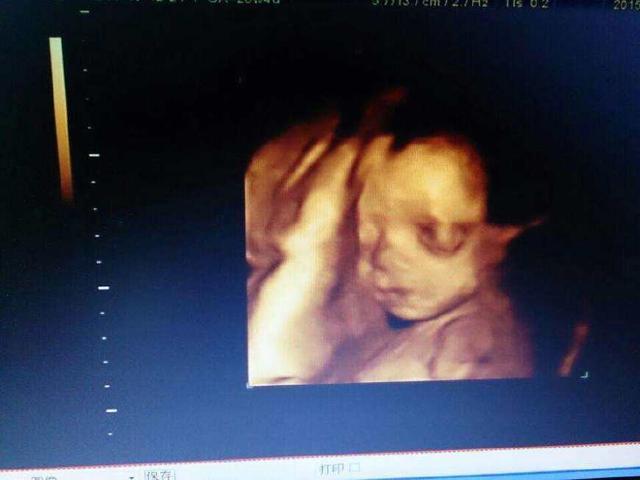 四维彩超怎么看? 五大项目帮你鉴别宝宝健康